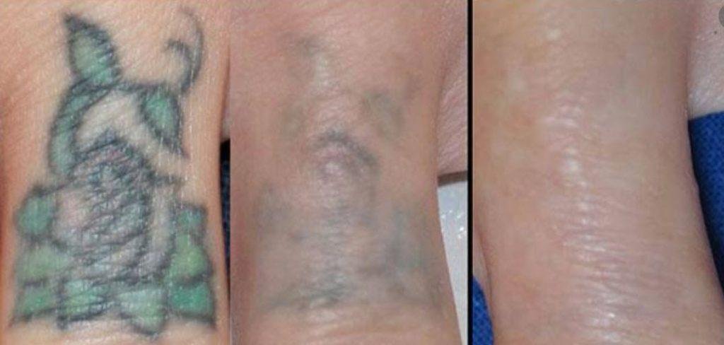 Laser Treatment